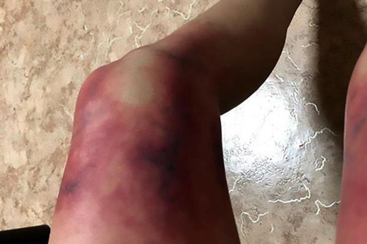 大腿冻疮图