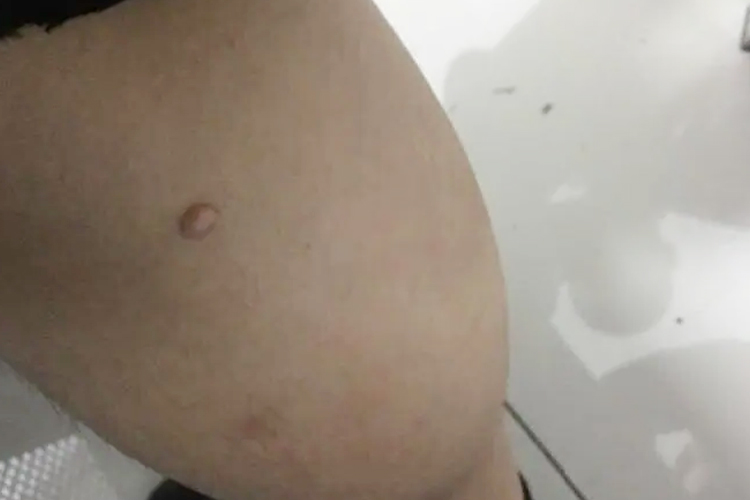 大腿瘢痕疙瘩图 大腿瘢痕疙瘩图