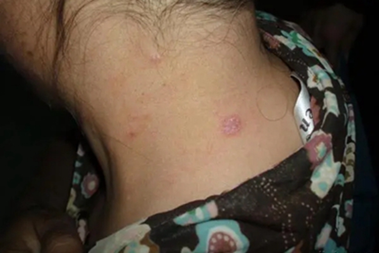 扁平苔藓样角化病后颈皮肤粗糙图