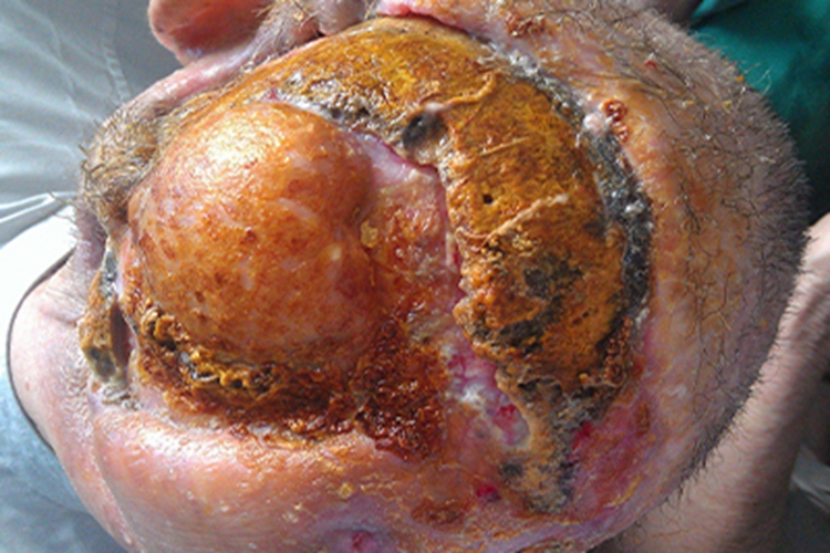 结节型基底细胞瘤后脑勺缺损图