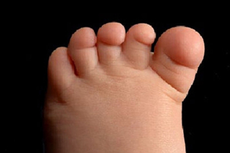 先天性无甲脚趾甲症状图 先天性无甲脚趾甲症状图