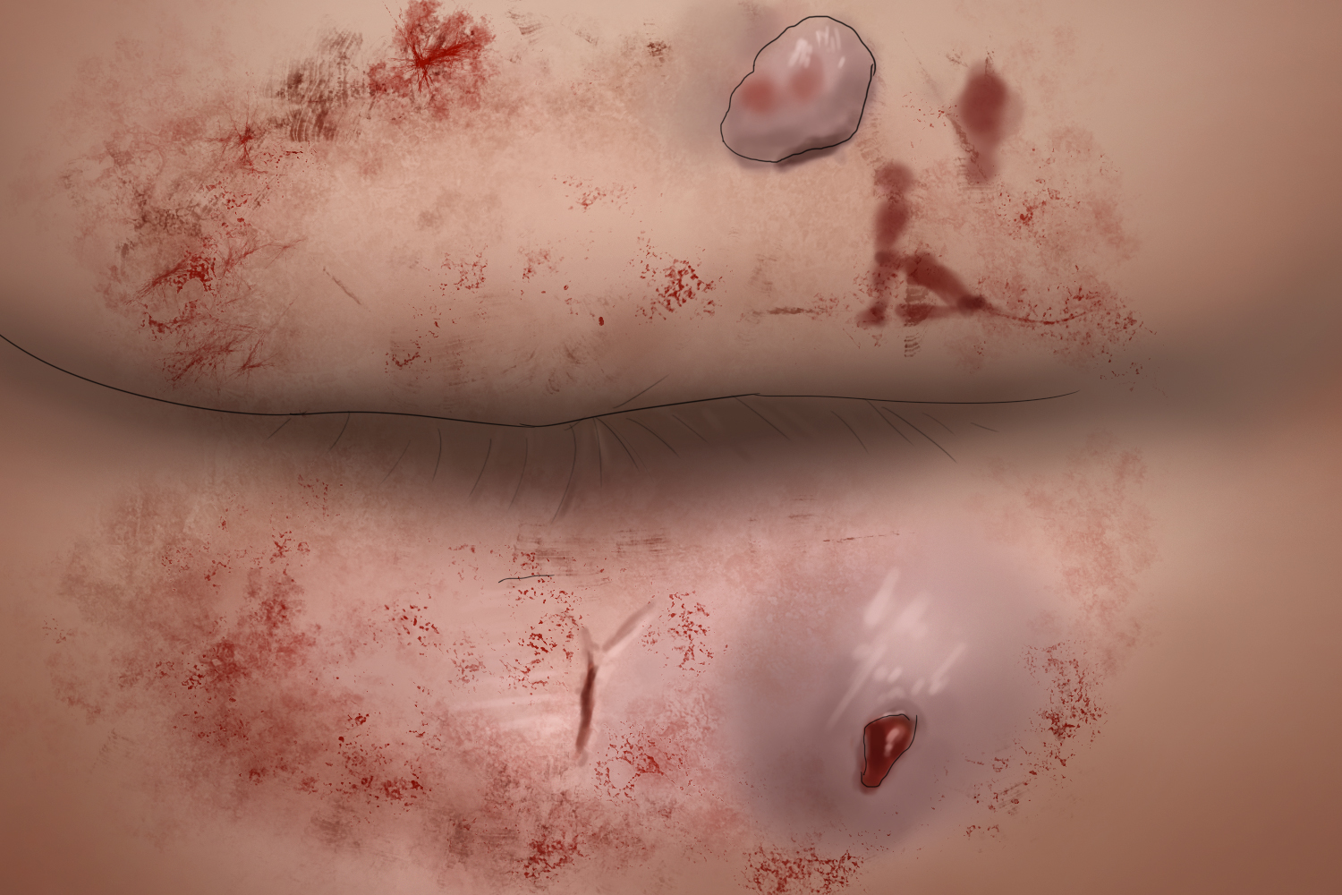 肛门周围脓肿图