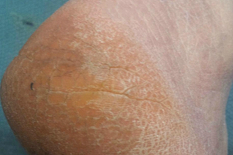 寻常型鱼鳞病皮肤增厚图