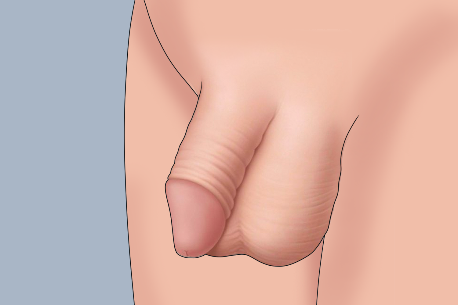 包皮术后恢复图