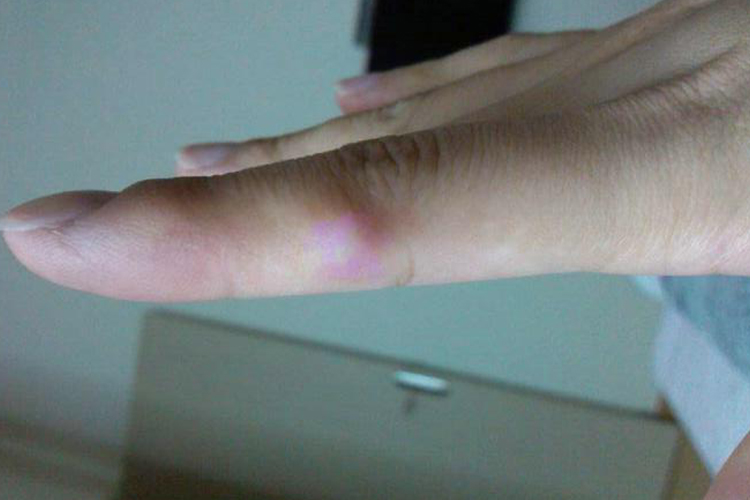 手上起了一个皮脂腺囊肿图