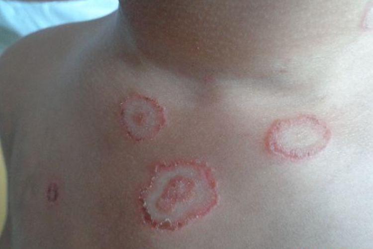 小孩体癣图 小孩体癣图