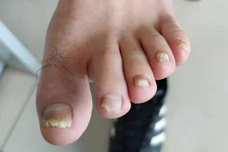 远端侧位甲下型甲癣图