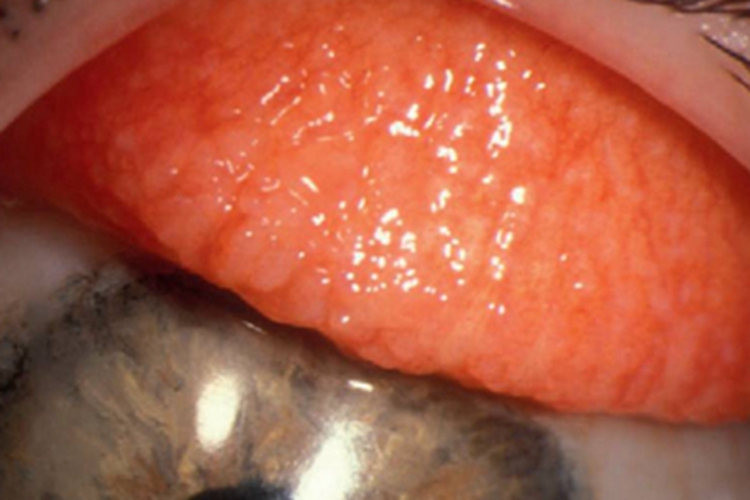 巨乳头性结膜炎充血图