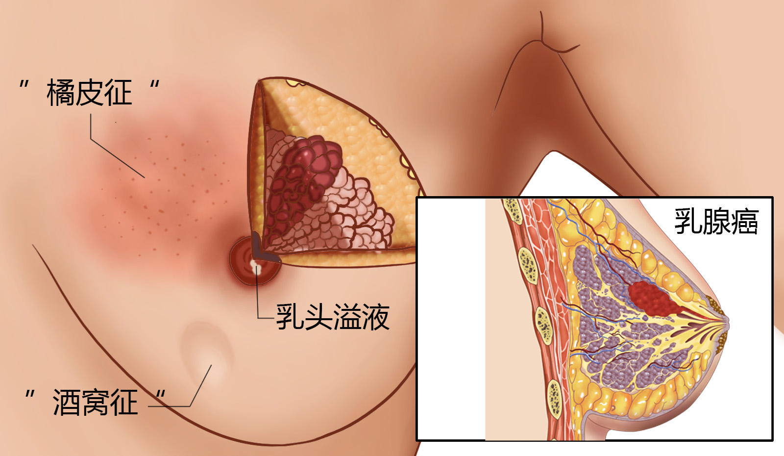 乳腺癌图