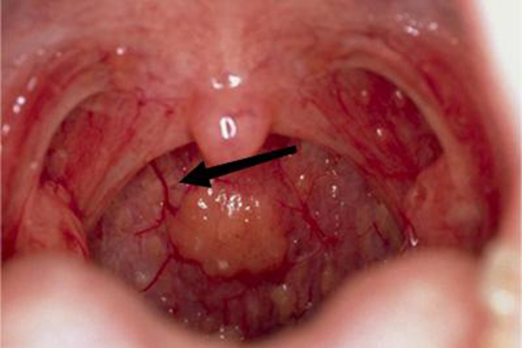 慢性咽炎血丝图