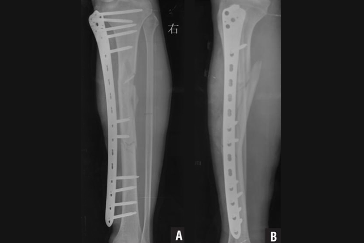 胫骨骨折钢钉图 胫骨骨折钢钉图