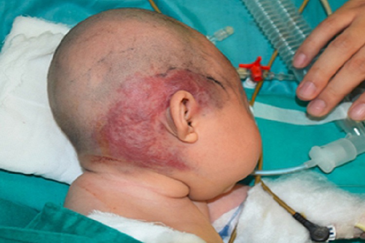 卡波西样血管内皮瘤长紫斑图