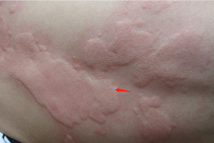 吃皮皮虾过敏红色风团图