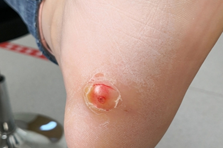 鸡眼脚后跟症状图 鸡眼脚后跟症状图