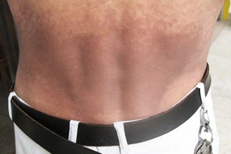 黑变病腰部症状图