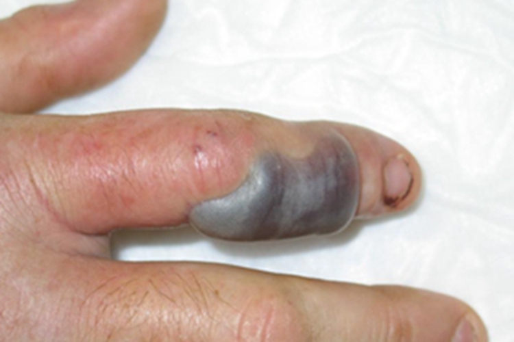 毒蛇咬伤手指水疱图