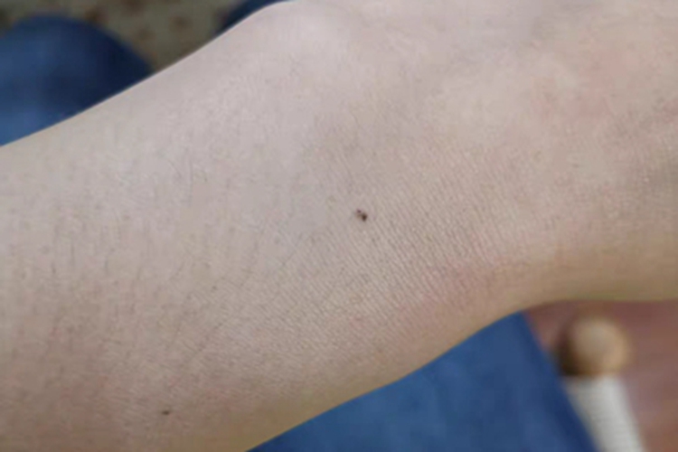 交界痣手腕黑痣图 交界痣手腕黑痣图