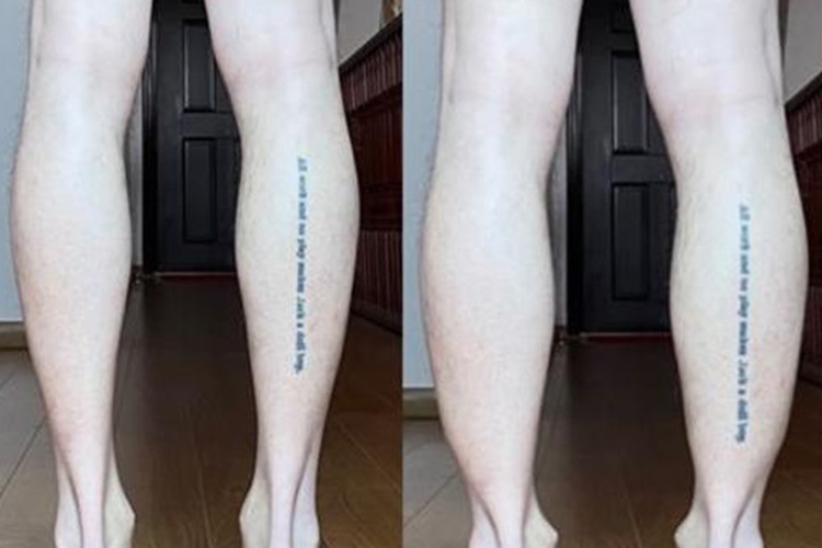 长跟腱、短跟腱图