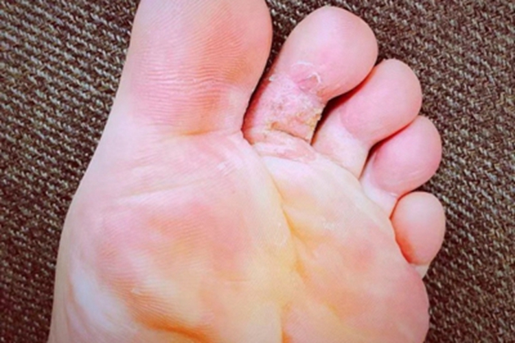 脚趾长水疱破了结黄痂图