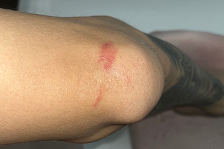 隐翅虫皮炎大腿红斑图