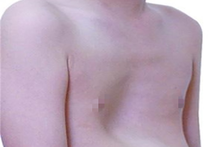 小孩子漏斗胸驼背图