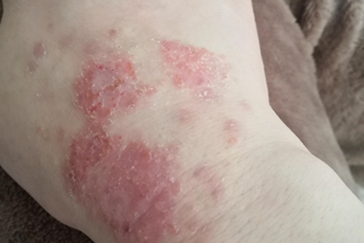 亚急性湿疹手腕红斑图 亚急性湿疹手腕红斑图