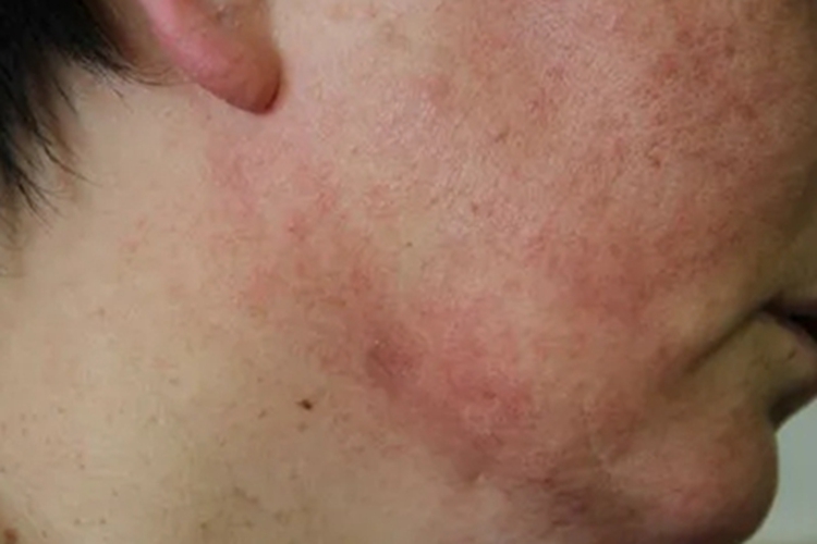 光线性肉芽肿面部症状图 光线性肉芽肿面部症状图