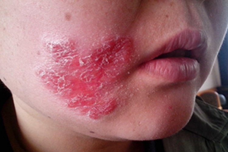 难辨认癣面部症状图