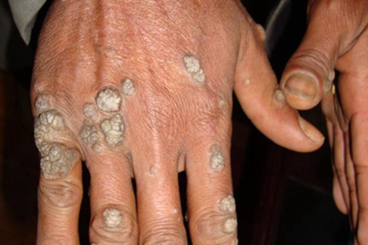 职业性疣赘手背症状图