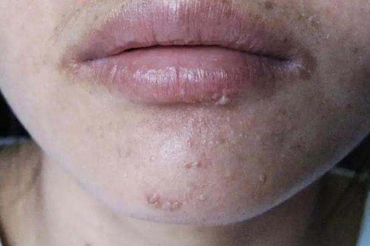 下嘴唇寻常疣图