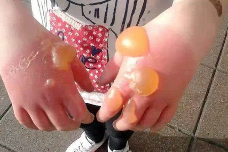 浅Ⅱ度烧伤图 浅Ⅱ度烧伤图