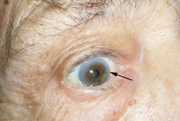 早发性角膜环图