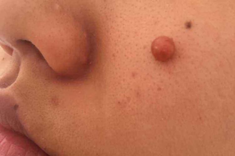 毛囊上皮瘤脸部长肉球图
