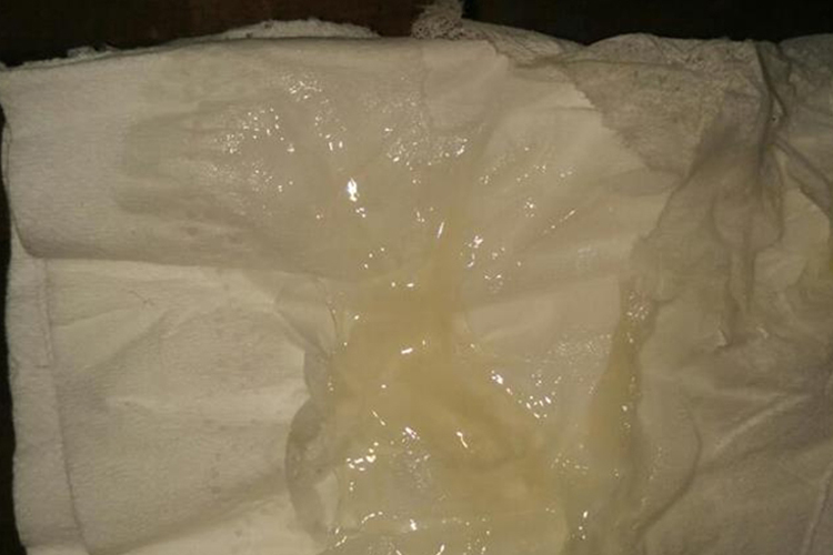 宫颈炎黄绿色分泌物图