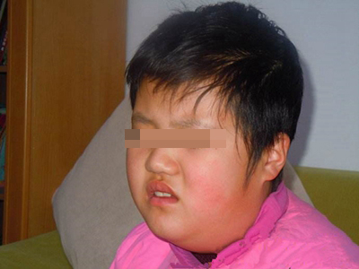 流行性腮腺炎的症状和图片 - 有来医生