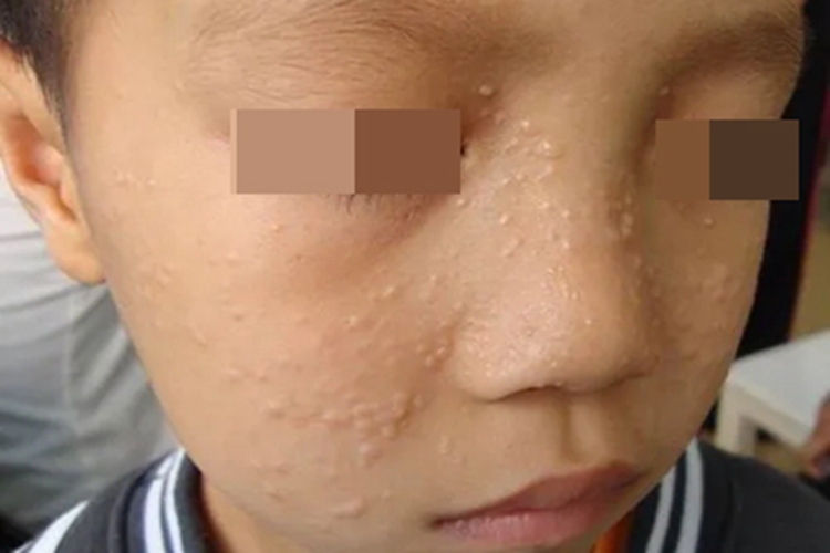 多发性毛发上皮瘤症状图