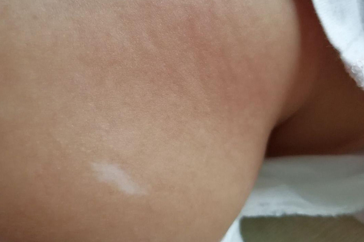 宝宝背部白癜风图