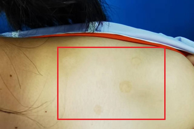 花斑糠疹肩部斑图