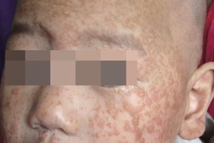 小儿发疹性黄瘤图 小儿发疹性黄瘤图