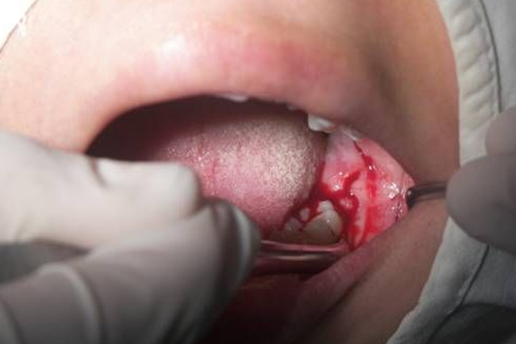 去骨和分牙图 去骨和分牙图