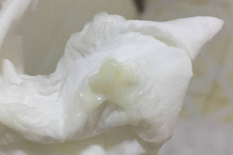 孕27周孕妇正常分泌物图