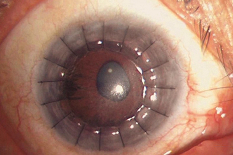 大泡性角膜病变角膜水肿图