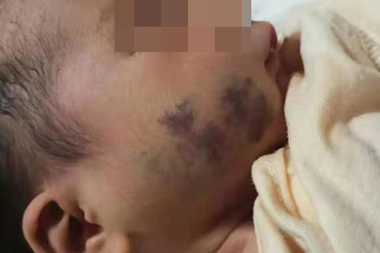 海绵状血管瘤面部症状图 海绵状血管瘤面部症状图