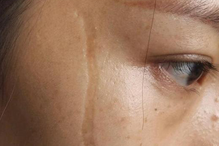 外伤皮肤萎缩凹陷图