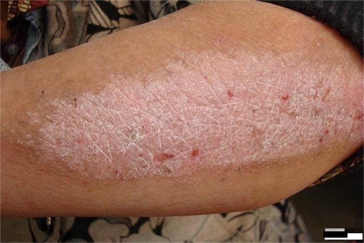 神经性皮炎大腿症状图