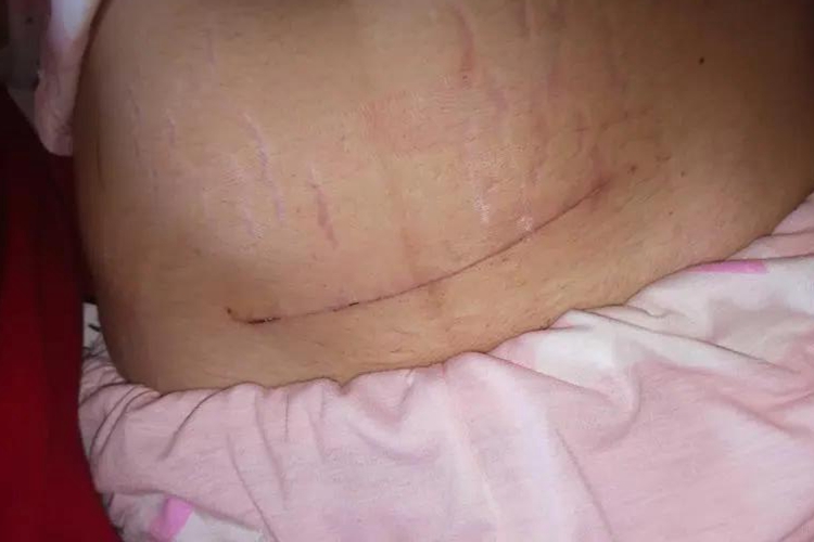 剖腹产术后肚子图
