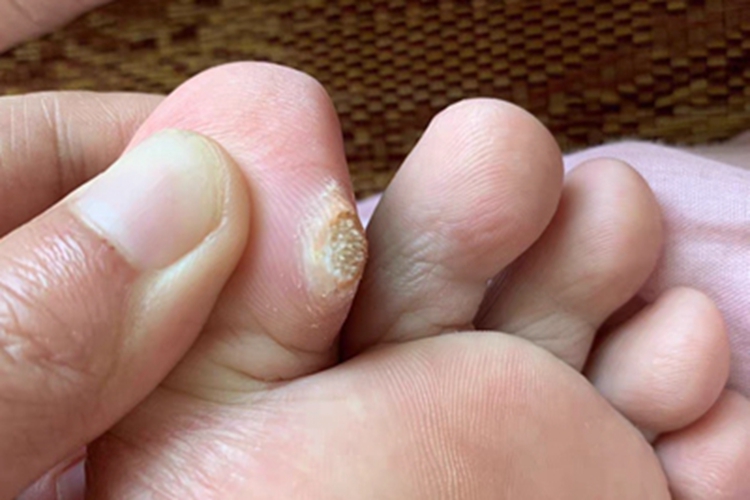 寻常疣白点图 寻常疣白点图