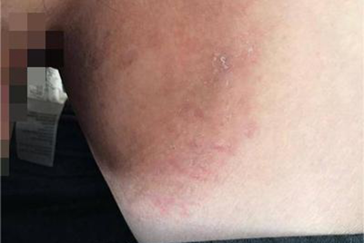 股癣大腿内侧红斑起皮图