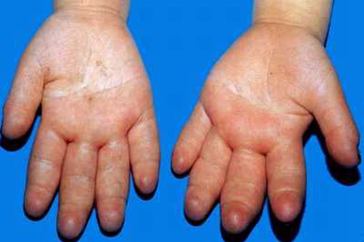 新生儿硬肿症手部肿图 新生儿硬肿症手部肿图