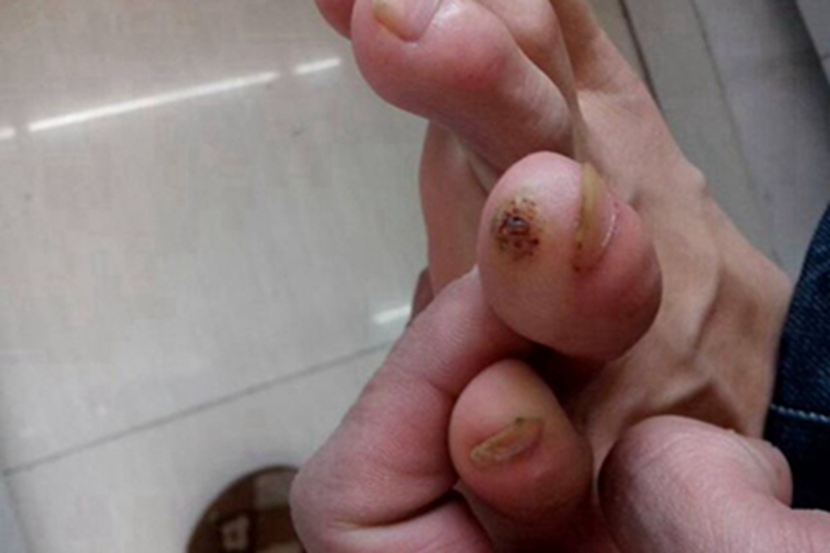 三期梅毒脚趾有个硬结节图